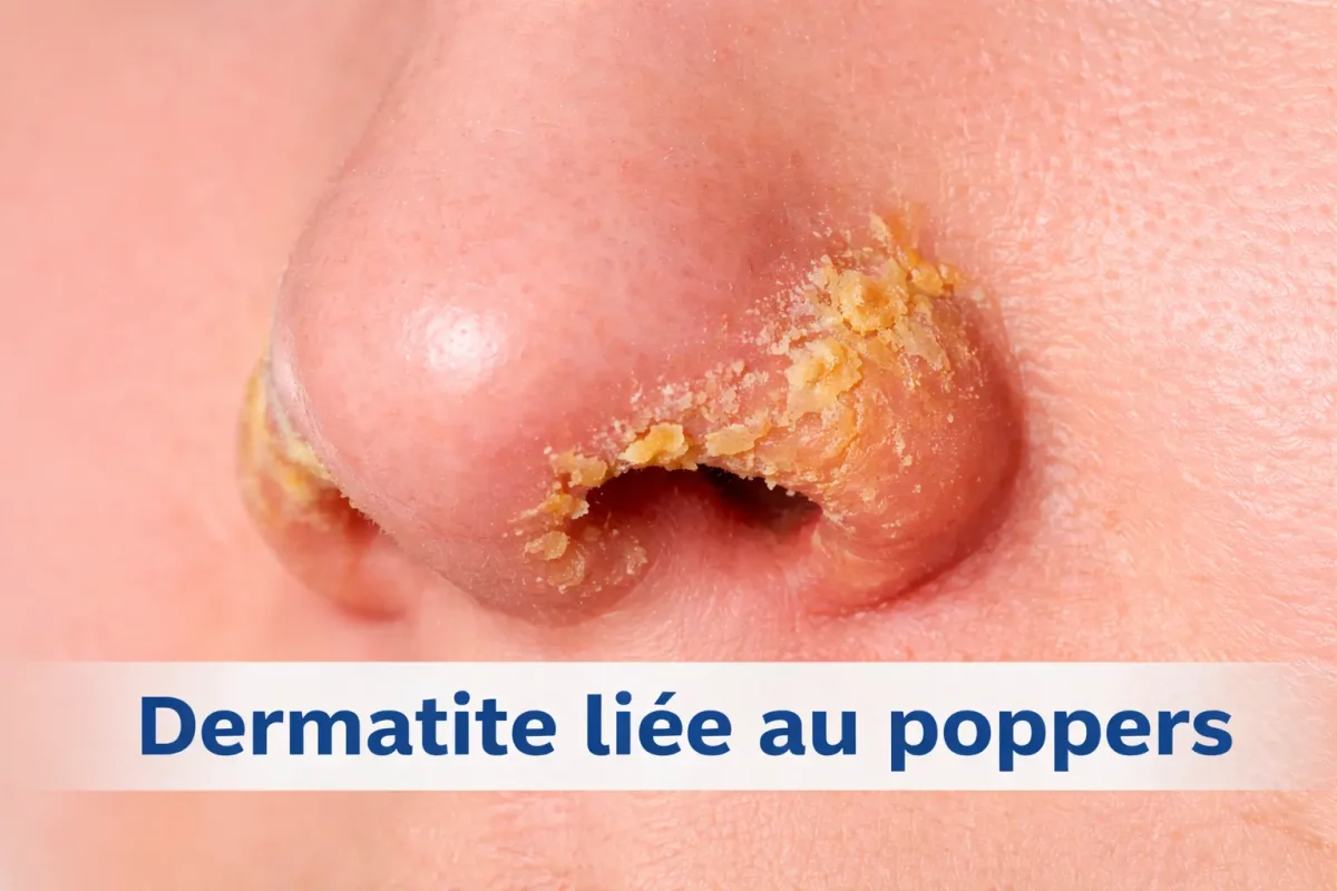 croute jaune narine et le poppers